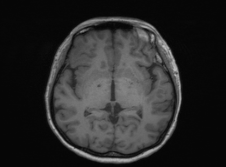 Cerebral ring enhancing lesions - cerebral metastases (Radiopaedia 44922-48817 Axial T1 235).jpg