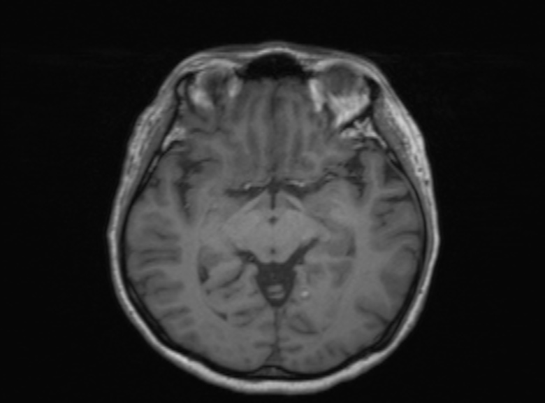 Cerebral ring enhancing lesions - cerebral metastases (Radiopaedia 44922-48817 Axial T1 247).jpg