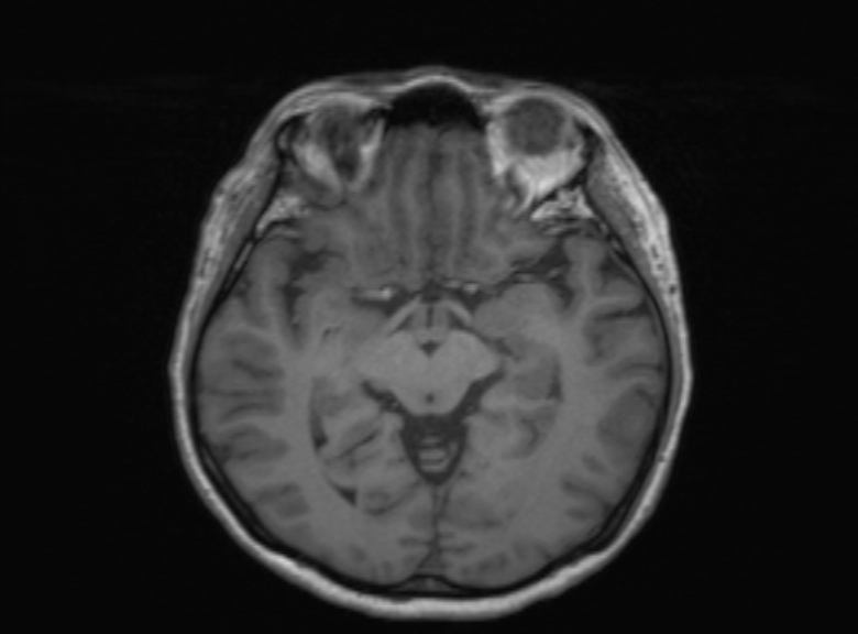 Cerebral ring enhancing lesions - cerebral metastases (Radiopaedia 44922-48817 Axial T1 249).jpg