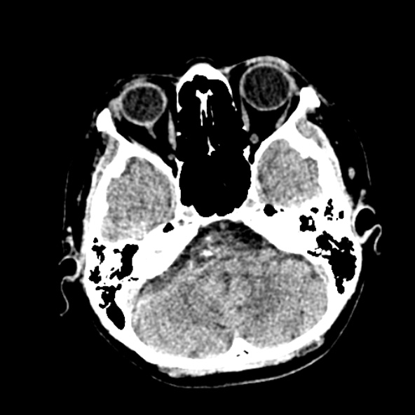 Cerebral ring enhancing lesions - cerebral metastases (Radiopaedia 44922-48818 Axial non-contrast 18).jpg