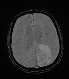 File:Cerebral toxoplasmosis (Radiopaedia 43956-47461 Axial SWI 25).jpg