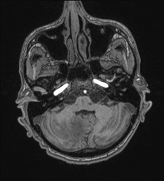 File:Cerebral toxoplasmosis (Radiopaedia 43956-47461 Axial T1 15).jpg