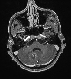 Cerebral toxoplasmosis (Radiopaedia 43956-47461 Axial T1 C+ 14).jpg