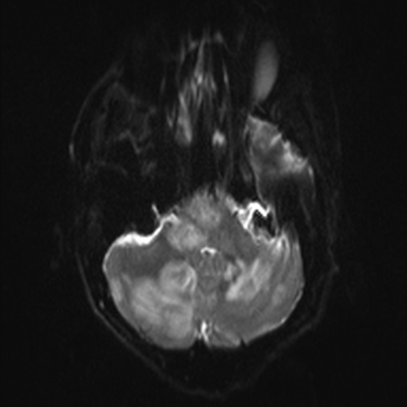 Cerebral toxoplasmosis (Radiopaedia 53993-60132 Axial DWI 6).jpg
