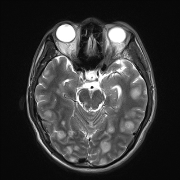 File:Cerebral toxoplasmosis (Radiopaedia 53993-60132 Axial T2 10).jpg