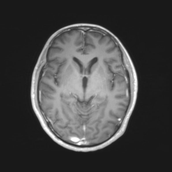 File:Cerebral toxoplasmosis (Radiopaedia 53993-61435 Axial T1 10).jpg