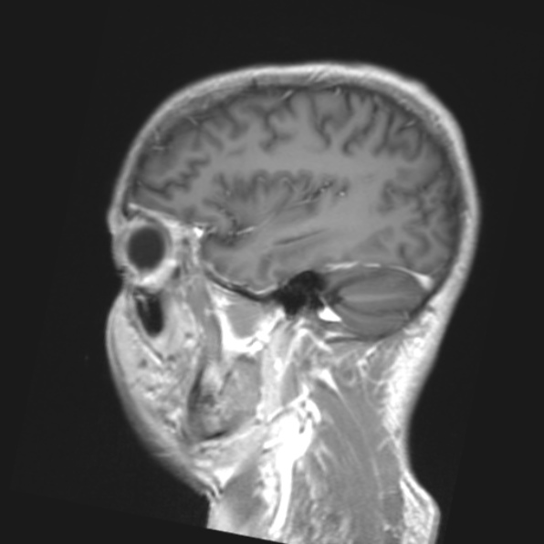 File:Cerebral toxoplasmosis (Radiopaedia 53993-61435 Coronal T1 10).jpg