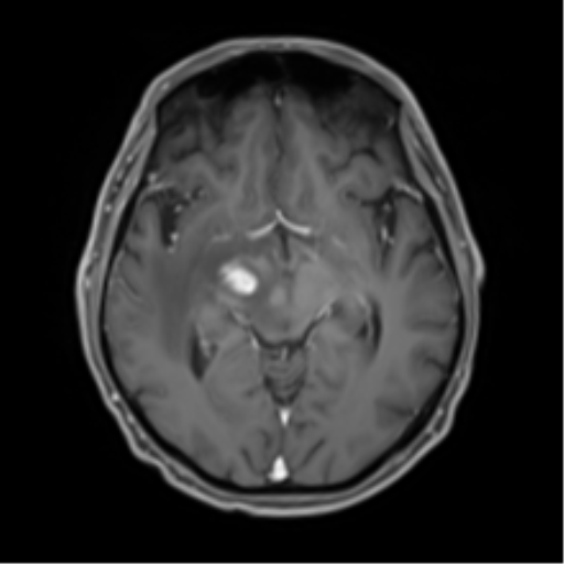 Cerebral toxoplasmosis (Radiopaedia 54575-60804 Axial T1 C+ 25).png