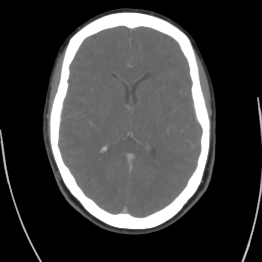 Cerebral venous infarct related to dural venous sinus thromboses (Radiopaedia 35292-36804 Axial C+ delayed 27).png