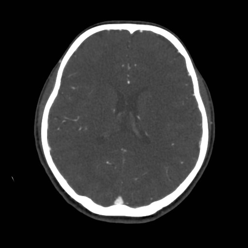Cerebral venous sinus thrombosis (Radiopaedia 40619-43227 A 135).jpg
