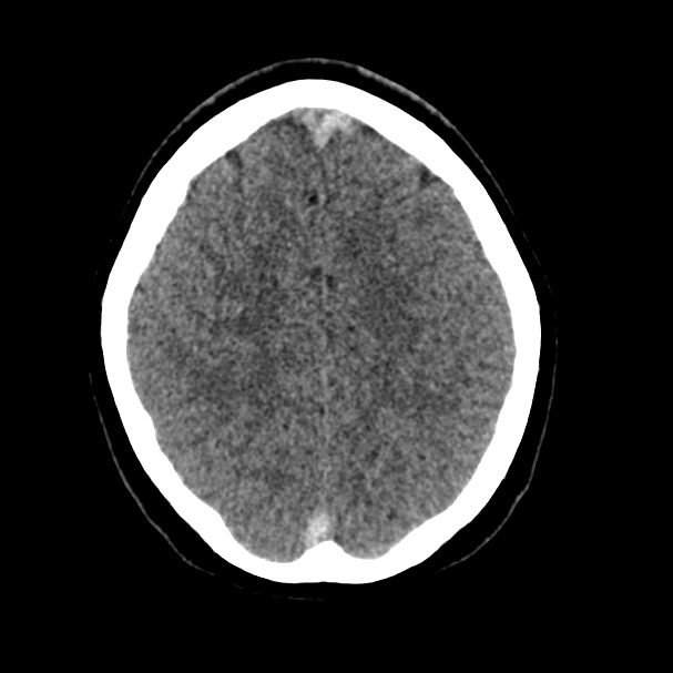 Cerebral venous sinus thrombosis (Radiopaedia 59224-66551 Axial non-contrast 34).jpg