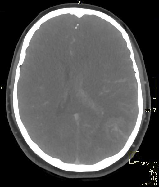 Cerebral venous sinus thrombosis (Radiopaedia 91329-108965 Axial venogram 48).jpg