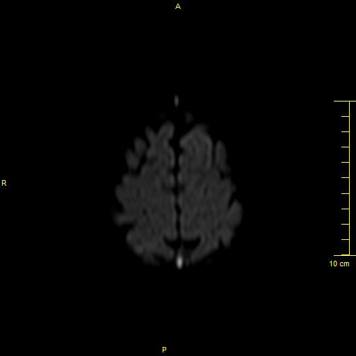File:Cerebral venous thrombosis (Radiopaedia 23288-23351 Axial DWI 39).JPG