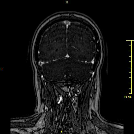 Cerebral venous thrombosis (Radiopaedia 23288-23351 MRV 143).JPG