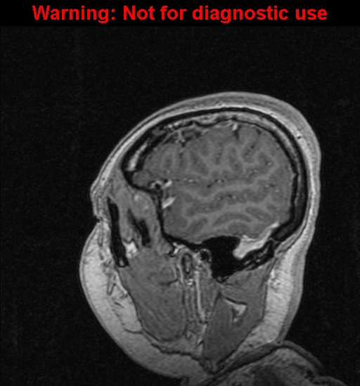 File:Cerebral venous thrombosis (Radiopaedia 37224-39208 Sagittal T1 C+ 24).jpg