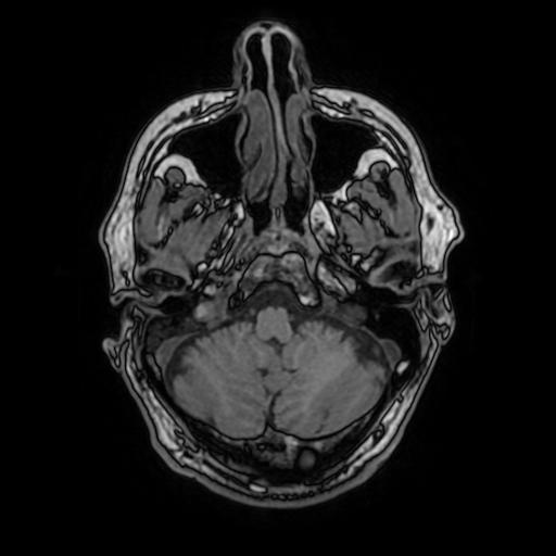 File:Cerebral venous thrombosis with secondary intracranial hypertension (Radiopaedia 89842-106957 Axial T1 46).jpg