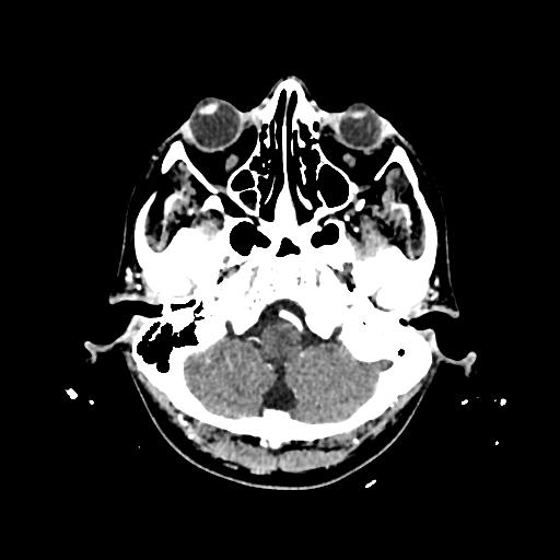 File:Cerebral venous thrombosis with venous hemorrhagic infarct (Radiopaedia 90354-107660 Axial with contrast 29).jpg