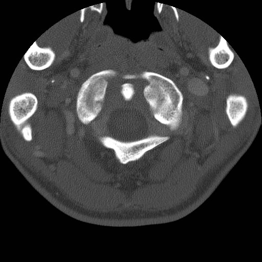 Cervical Pott disease (Radiopaedia 20374-20286 Axial bone window 17).jpg