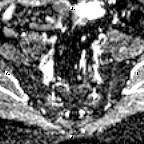 File:Cervical adenocarcinoma (Radiopaedia 65011-73985 Axial ADC 28).jpg