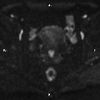 Cervical adenocarcinoma (Radiopaedia 65011-73985 Axial DWI 50).jpg