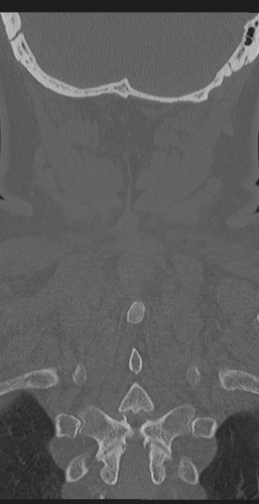 Cervical canal stenosis due to ossification of the posterior longitudinal ligament (Radiopaedia 47260-51823 Coronal bone window 57).png