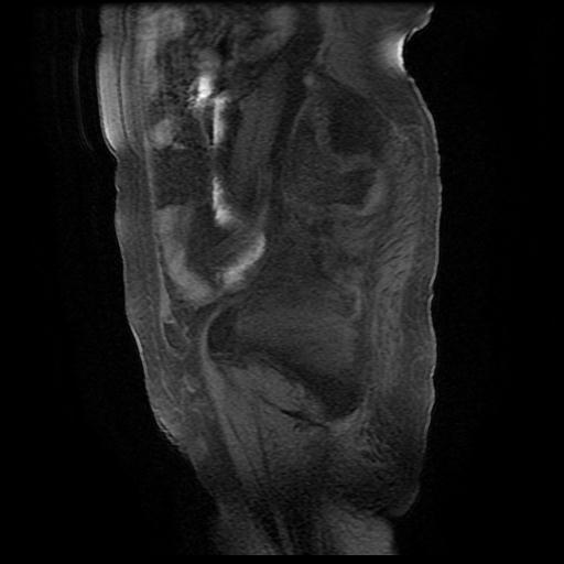 File:Cervical carcinoma (Radiopaedia 78847-91705 Sagittal T1 fat sat 3).jpg