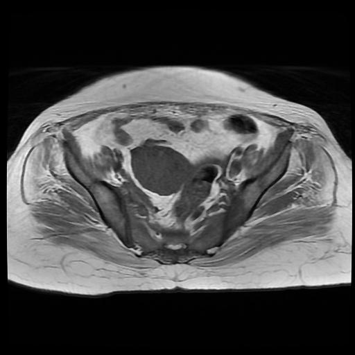 File:Cervical carcinoma (Radiopaedia 88010-104555 Axial T1 8).jpg