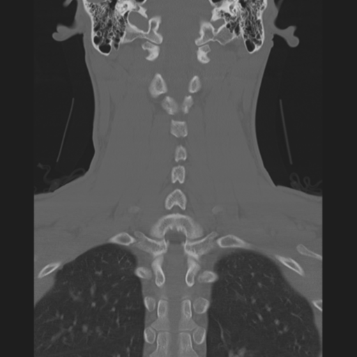 Cervical intercalary bone (Radiopaedia 35211-36748 Axial bone window 1).png
