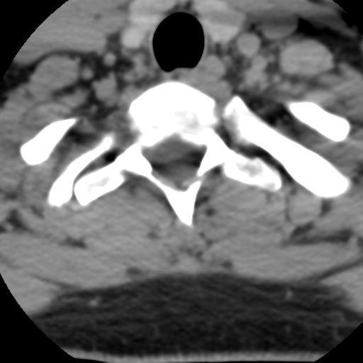 Cervical schwannoma (Radiopaedia 57979-64974 Axial non-contrast 57).png