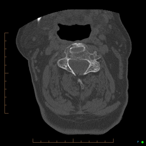 File:Cervical spine fracture - ankylosing spondylitis (Radiopaedia 76835-88706 Axial bone window 82).jpg