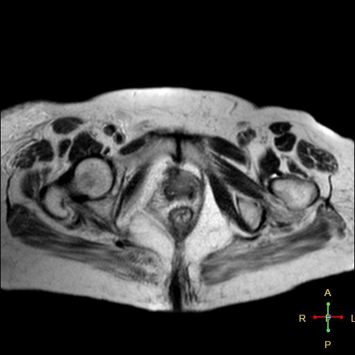 File:Cervical stump squamous cell carcinoma (Radiopaedia 48049-52858 Axial T2 1).jpg