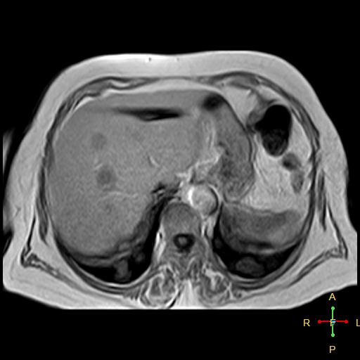 File:Cervical stump squamous cell carcinoma (Radiopaedia 48049-52858 H 14).jpg