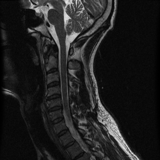 File:Cervical vertebrae metastasis (Radiopaedia 78814-91667 Sagittal T2 6).png