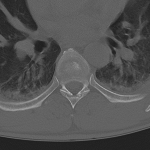 Chance fracture (Radiopaedia 33854-35020 Axial bone window 43).png