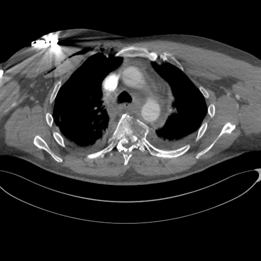 File:Chest multitrauma - aortic injury (Radiopaedia 34708-36147 A 100).png