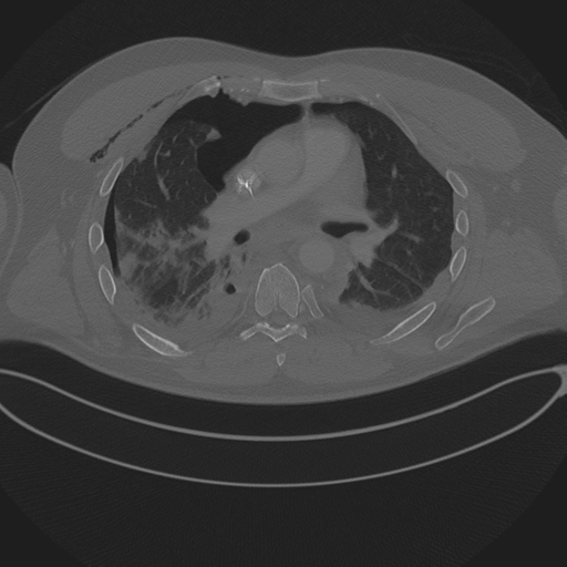 Chest multitrauma - aortic injury (Radiopaedia 34708-36147 Axial bone window 141).png
