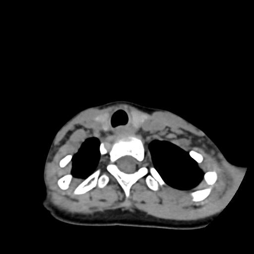 Chiari I with syrinx and skull base anomalies (Radiopaedia 89444-106412 Axial non-contrast 123).jpg