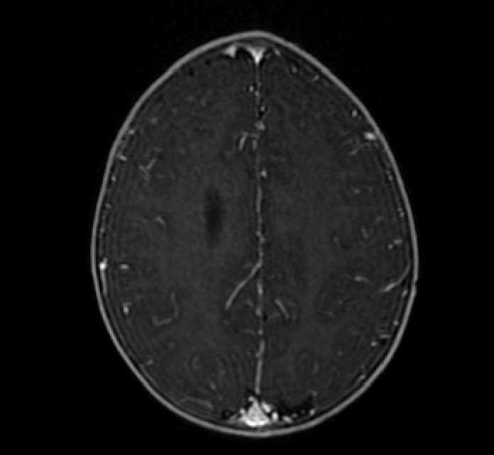 Chiasmatic-hypothalamic glioma (Radiopaedia 90079-107252 Axial T1 C+ 66).jpg