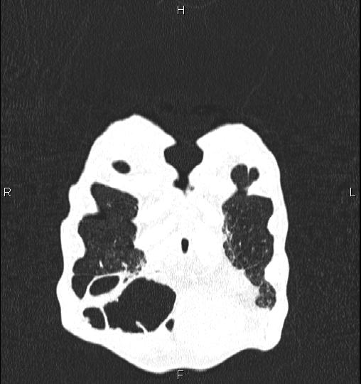 Chilaiditi sign (Radiopaedia 88839-105611 Coronal lung window 5).jpg