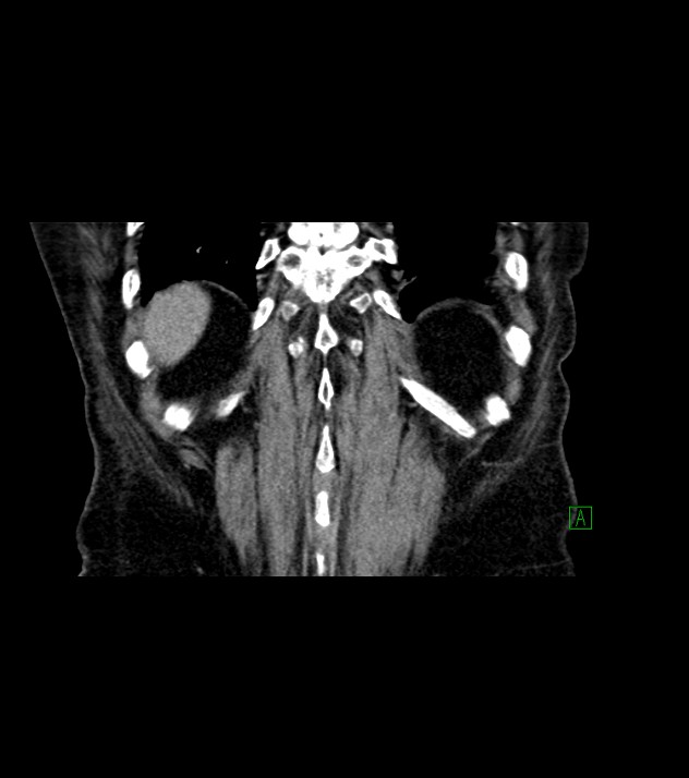 Cholangiocarcinoma with cerebral metastases (Radiopaedia 83519-98629 Coronal C+ delayed 72).jpg