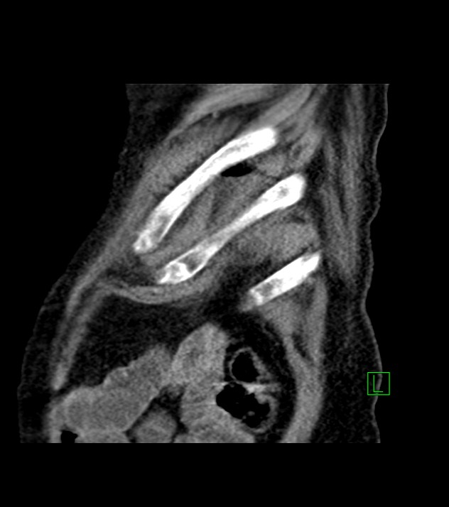 Cholangiocarcinoma with cerebral metastases (Radiopaedia 83519-98629 Sagittal C+ delayed 10).jpg