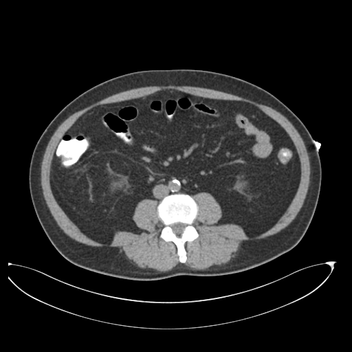 File:Cholecystitis with focal perforation and hepatic abscess (Radiopaedia 37189-38945 Coronal non-contrast 1).png