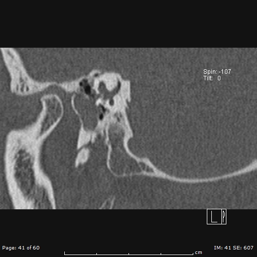 File:Cholesteatoma - external auditory canal (Radiopaedia 88452-105096 Sagittal bone window 41).jpg