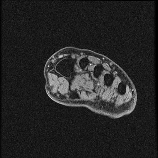 File:Chondroblastoma - midfoot (Radiopaedia 64831-73765 F 23).jpg