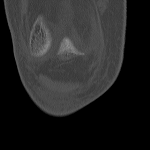 Chondrocalcinosis (Radiopaedia 16275-15955 Coronal bone window 12).jpg