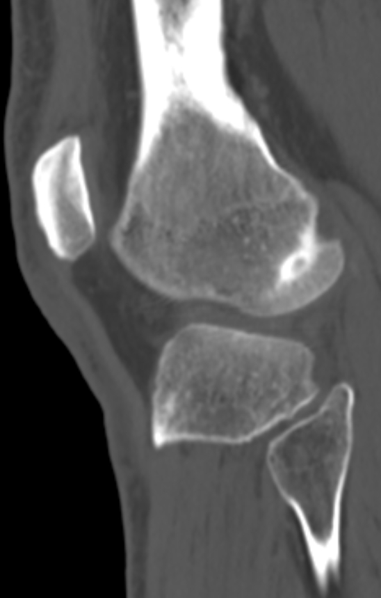 Chondrocalcinosis (Radiopaedia 82862-97173 Sagittal bone window 53).jpg