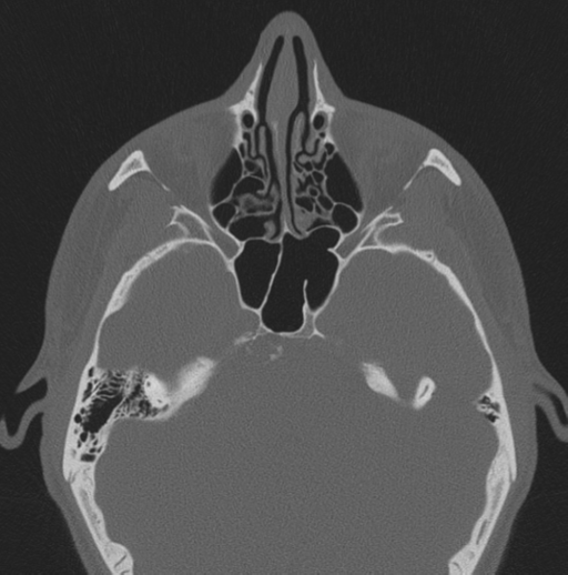 Chondrosarcoma (clivus) (Radiopaedia 46895-51425 Axial bone window 40).png