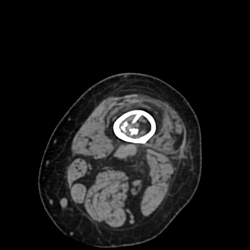 Chondrosarcoma - femur (Radiopaedia 64187-72954 Axial non-contrast 10).jpg