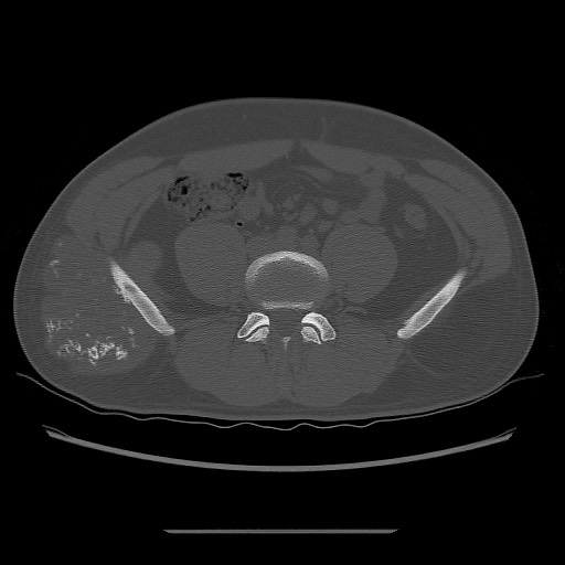 File:Chondrosarcoma of iliac wing (Radiopaedia 63861-72599 Axial bone window 34).jpg