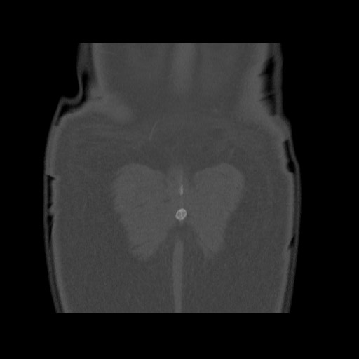 Chondrosarcoma of iliac wing (Radiopaedia 63861-72599 Coronal bone window 108).jpg